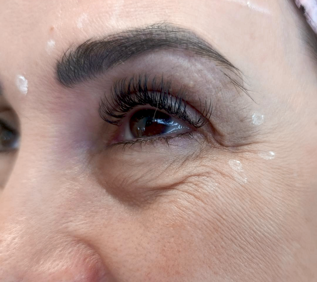 Resultado ampliado do procedimento Botox