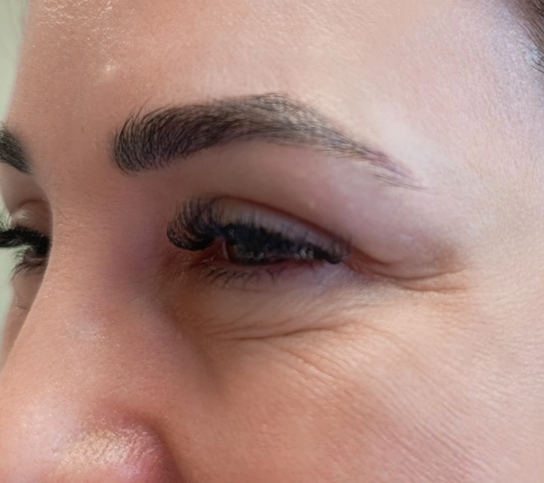 Resultado do procedimento Botox