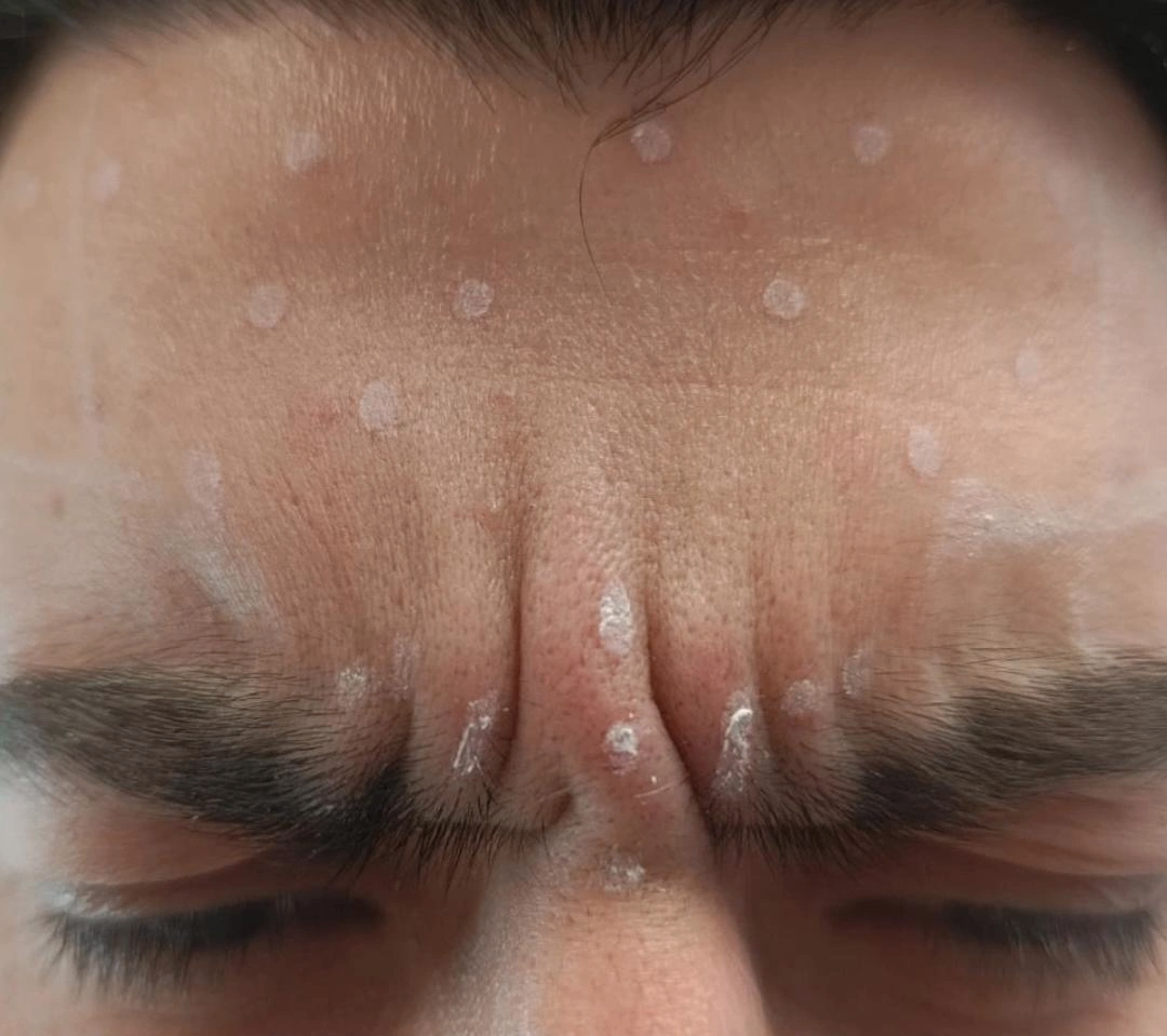 Resultado ampliado do procedimento Botox