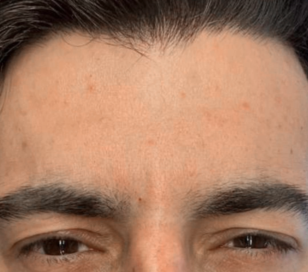 Resultado ampliado do procedimento Botox