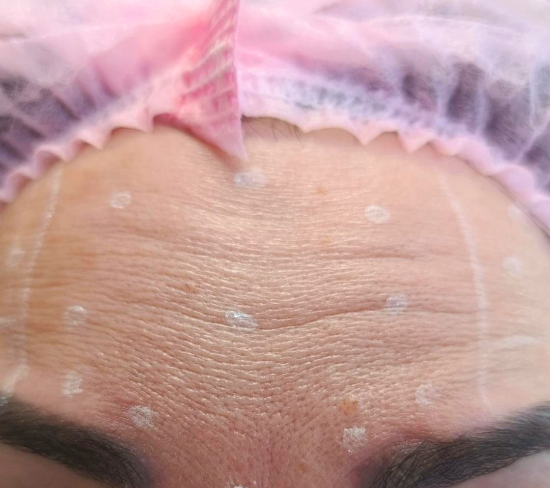 Resultado ampliado do procedimento Botox