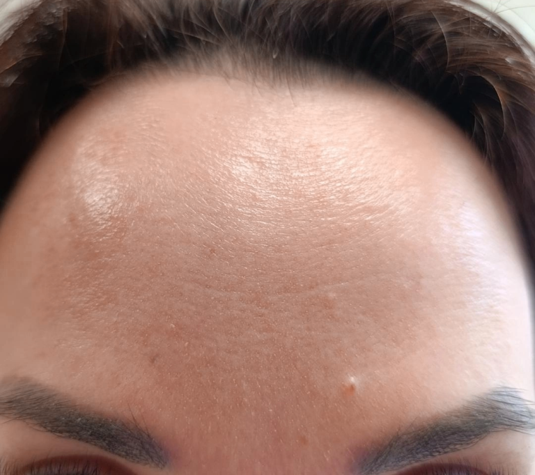 Resultado do procedimento Botox