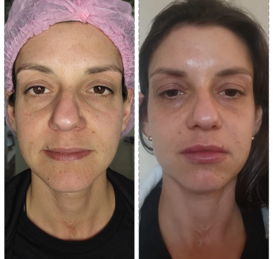 Imagem 1 do protocolo de rejuvenescimento facial